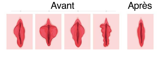 Vaginoplastie tunisie avant apres