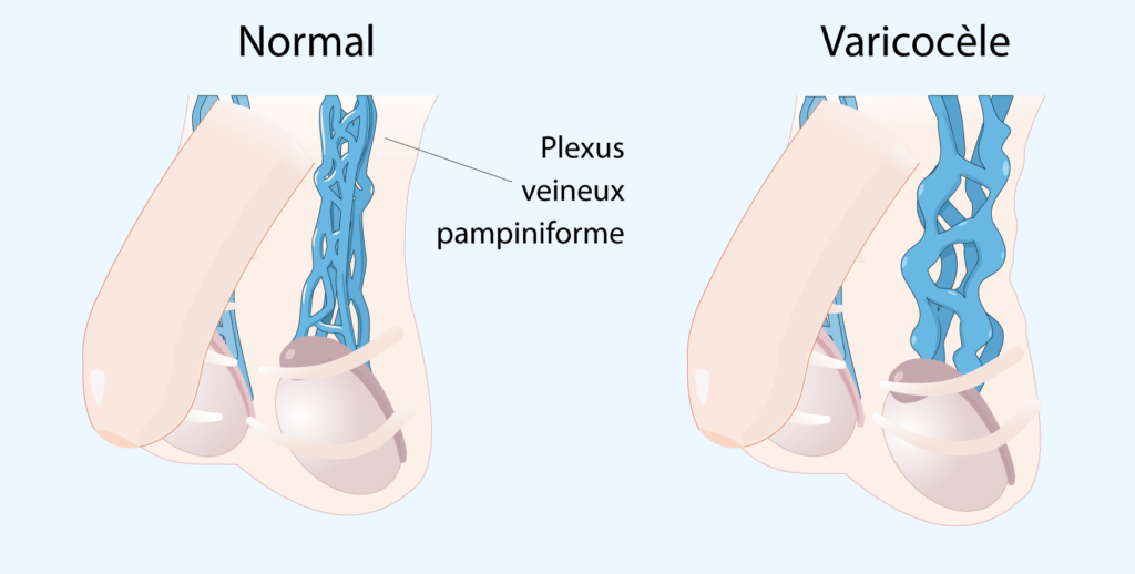 chirurgie de la varicocèle