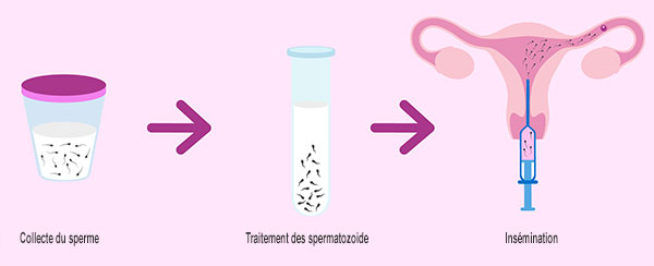 insemination-artificielle-tunisie