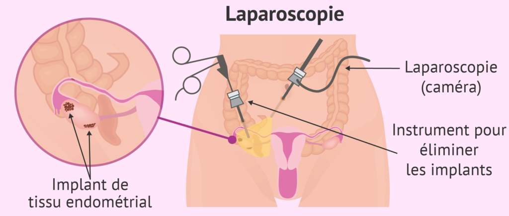 laparoscopie